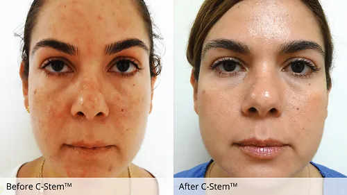 C-Stem®