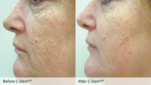 C-Stem®